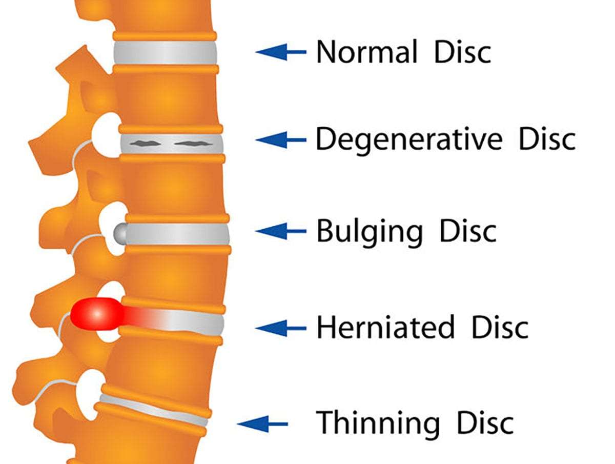 Herniated or Bulging Discs