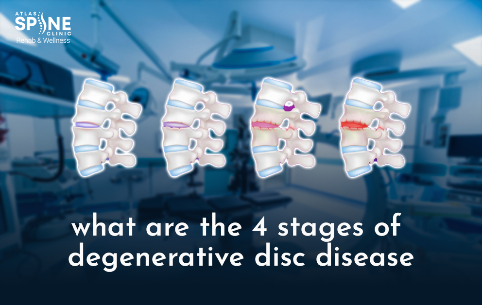 What Are the 4 Stages of Degenerative Disc Disease?