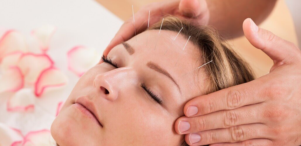 Benefits of Acupuncture for Mental Health