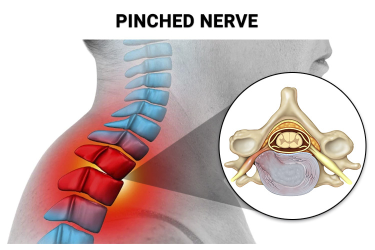 can chiropractor fix pinched nerve