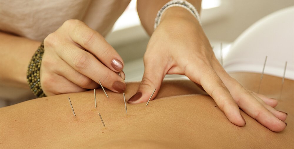 Acupuncture for Pain Management