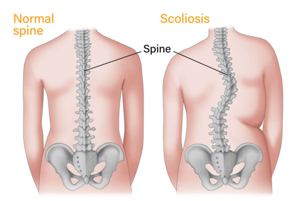 Scoliosis Chiropractor