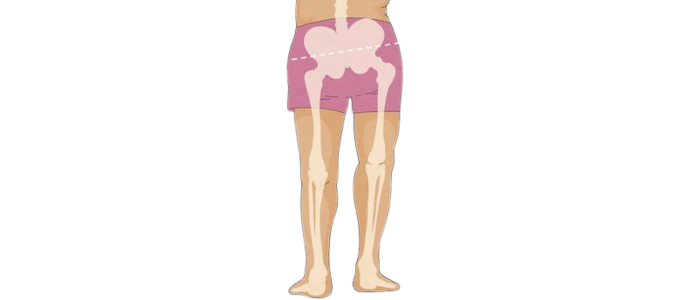 Uneven Hips Foot & Lower Limb Issues