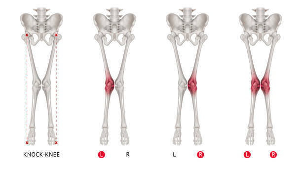 Signs & Symptoms of Knee Valgus