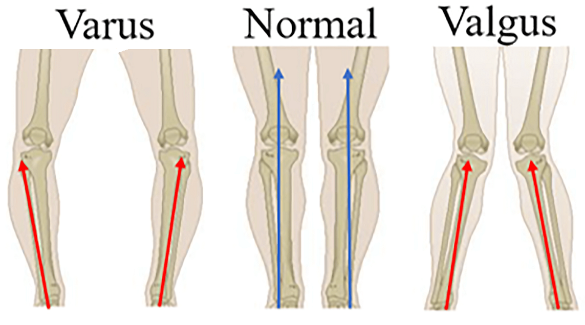 knee valgus