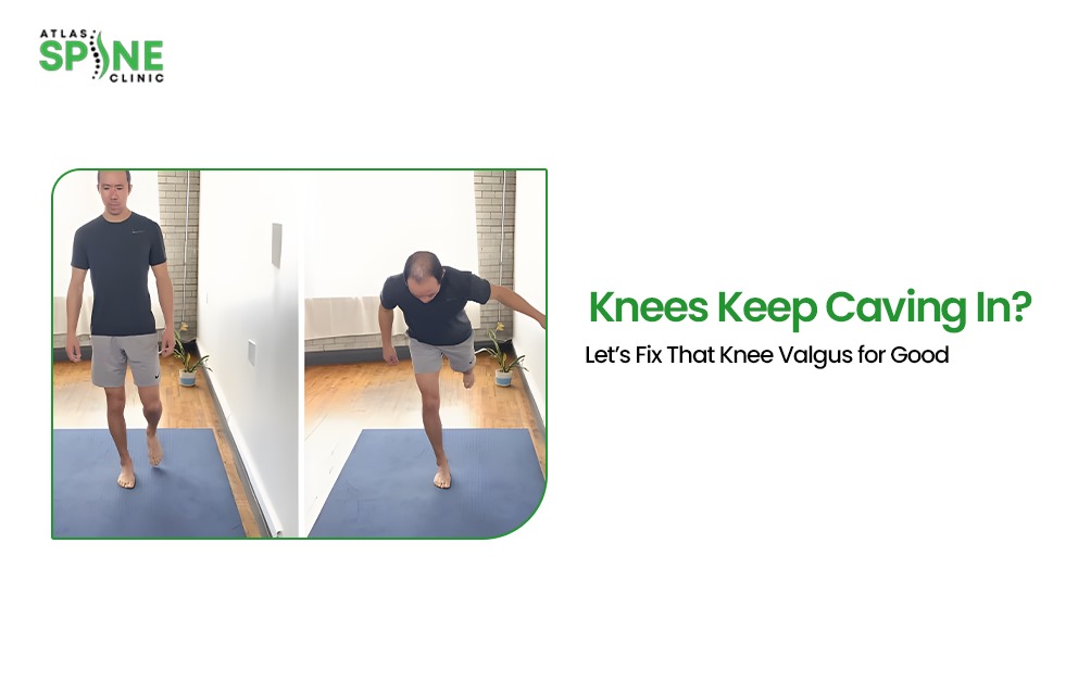 knee valgus