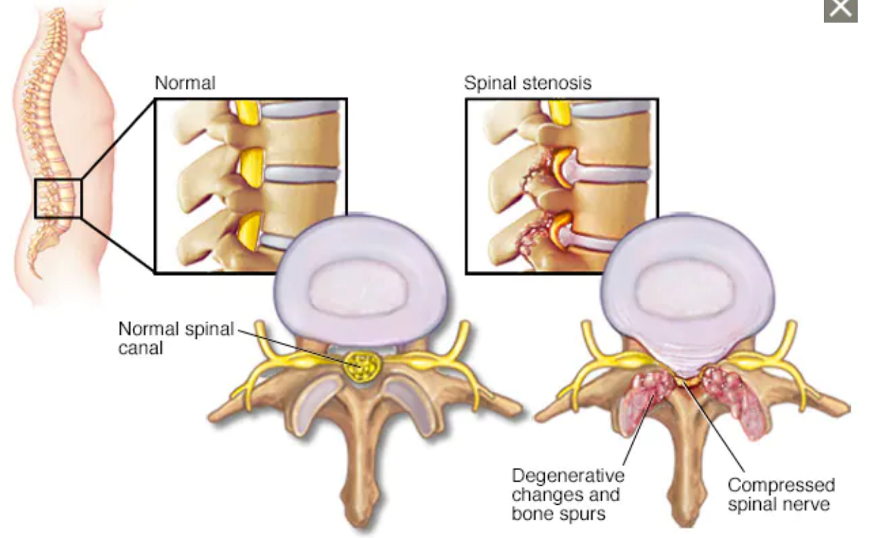 Spinal stenosis 