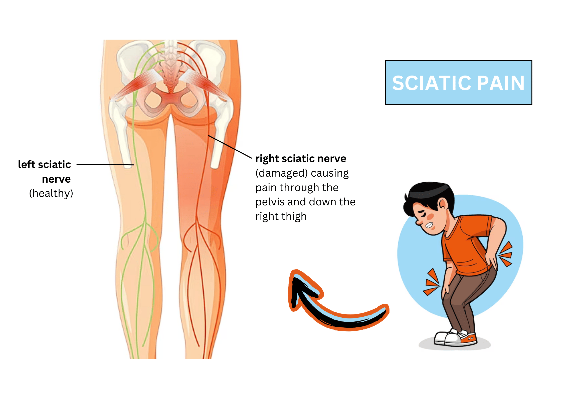 How Sciatica Affects Daily Life