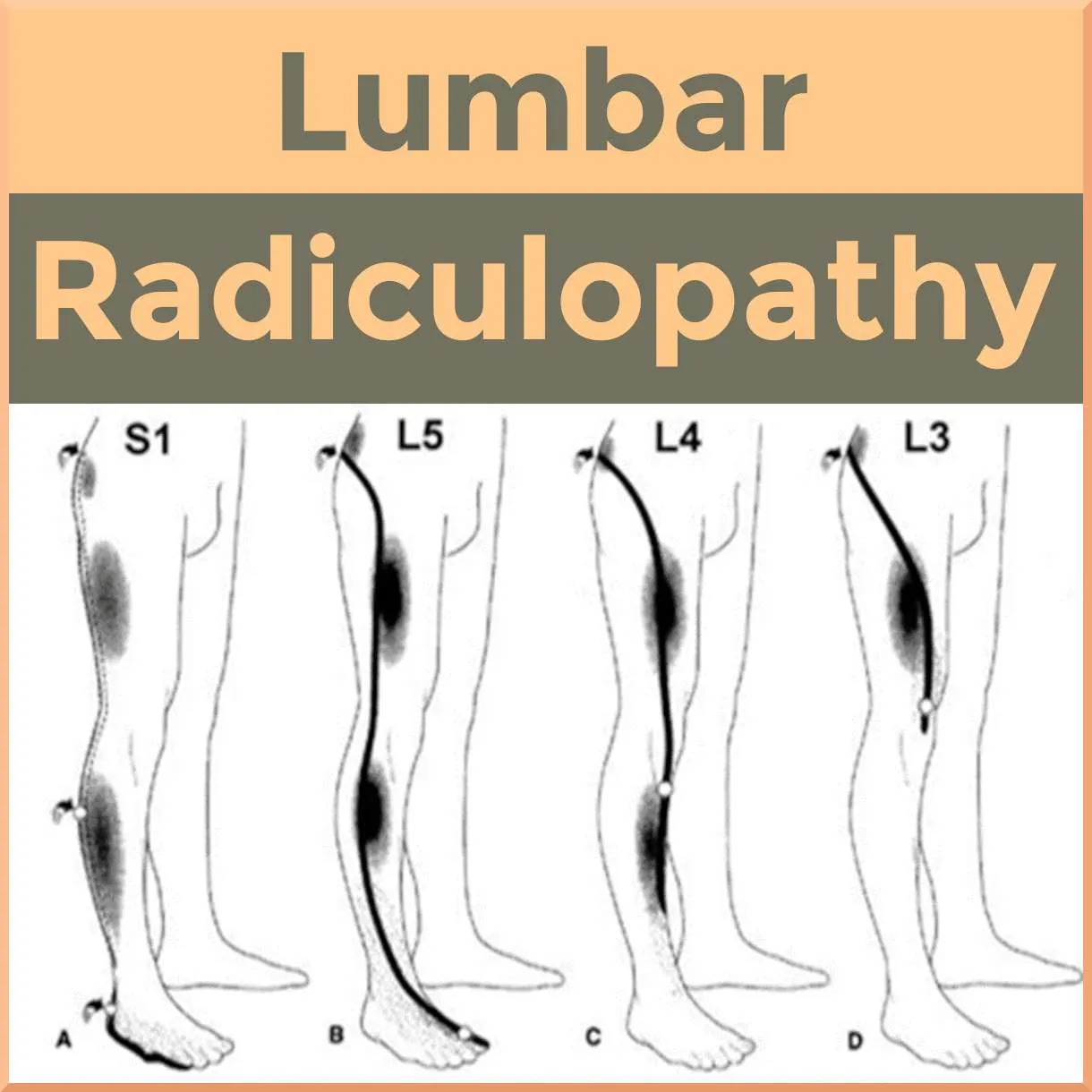 Lumbar Radiculopathy
