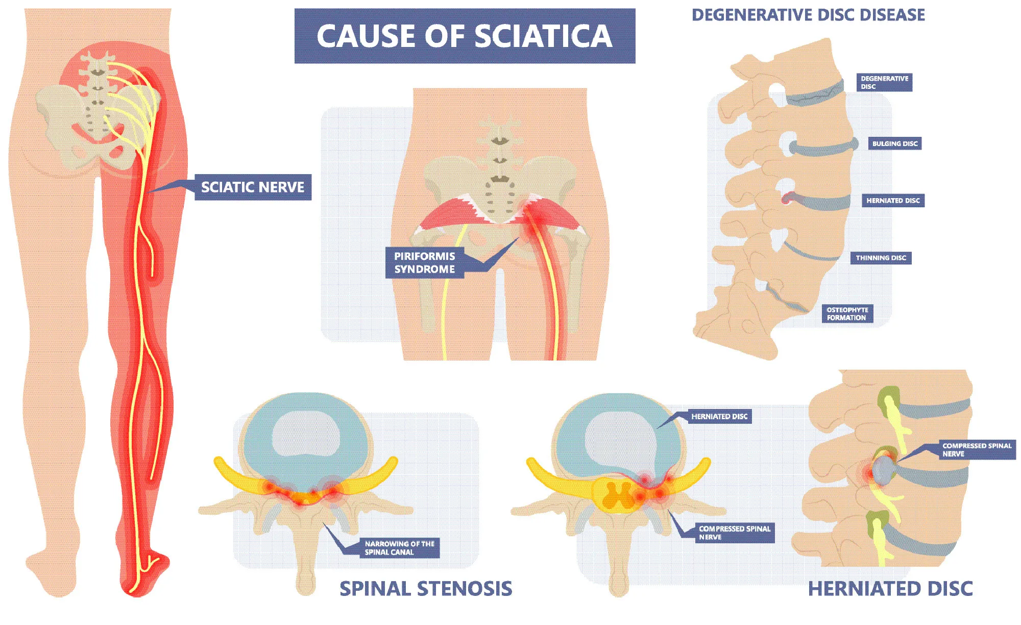 Causes of Sciatica 