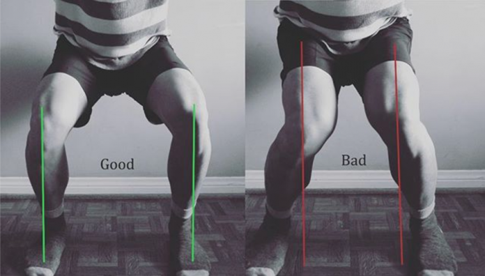 Step-by-Step Fixes for Knee Valgus