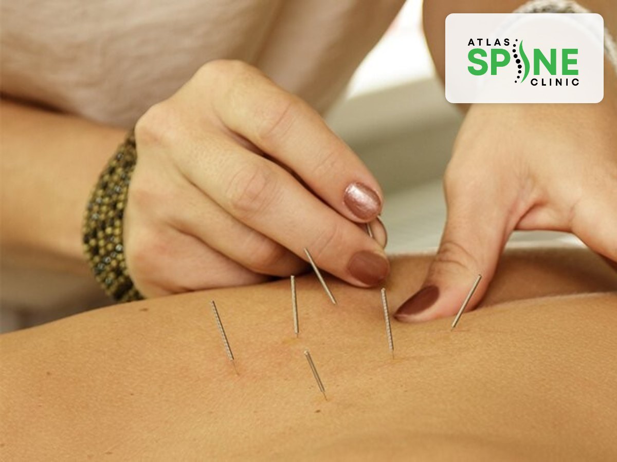 Acupuncture treatment in Scarborough at Atlas Spine Clinic.