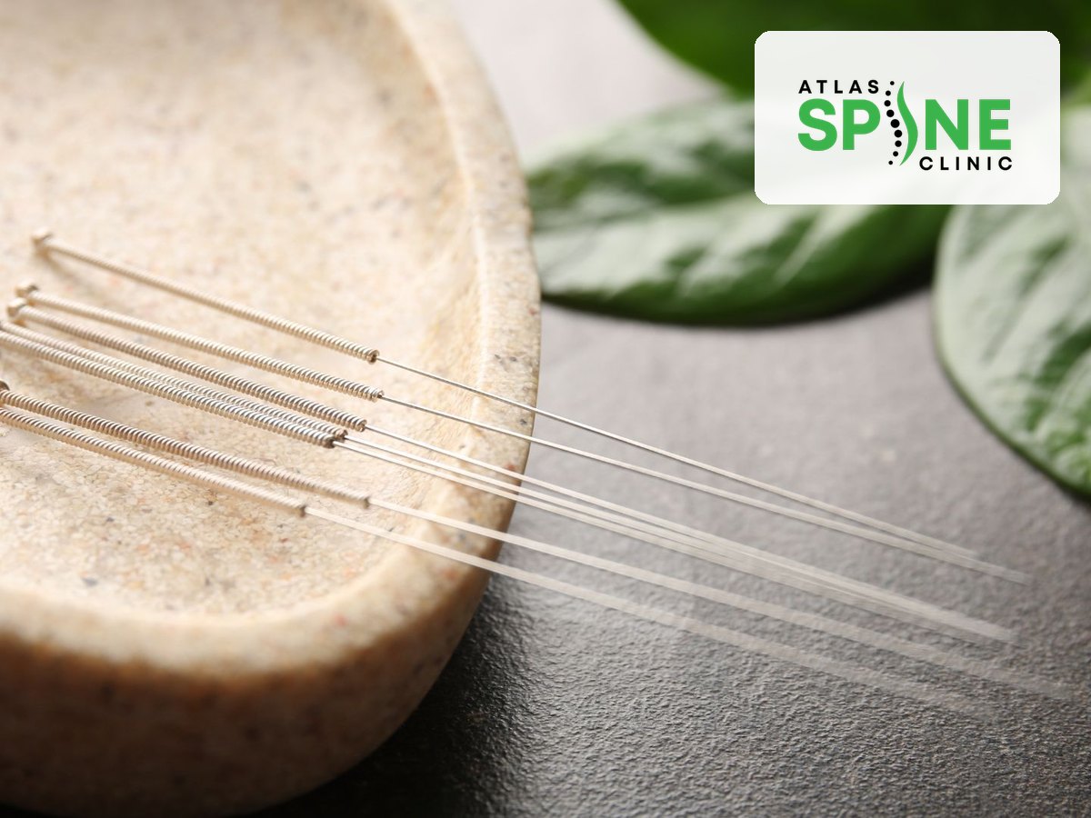 Acupuncture needles in a ceramic dish, used for anxiety and stress relief at Atlas Spine Clinic in Scarborough