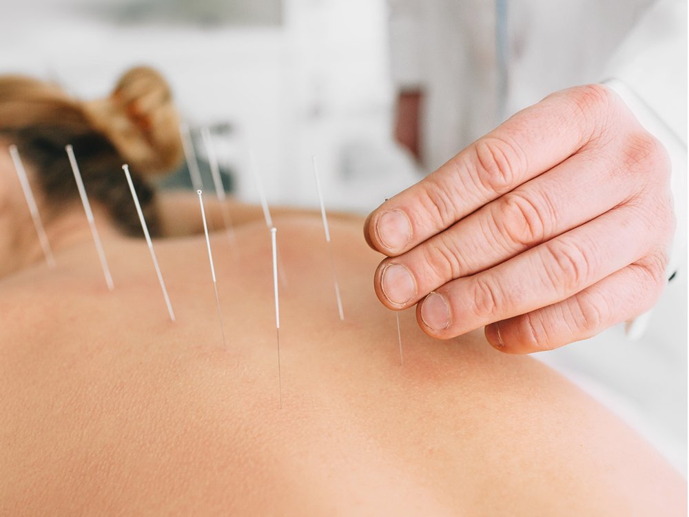 Acupuncture / Electro Acupuncture